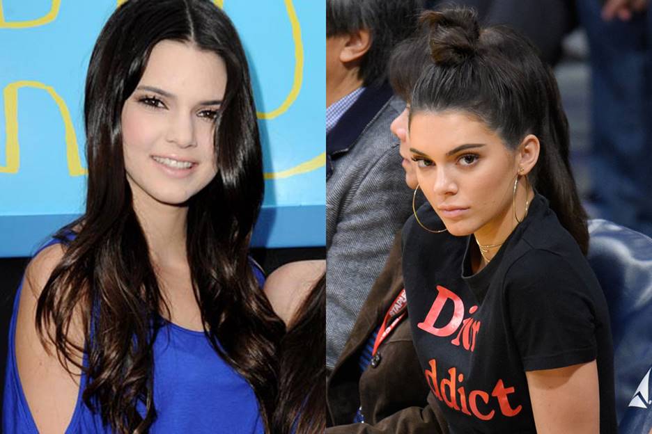 Kendall Jenner Before and After