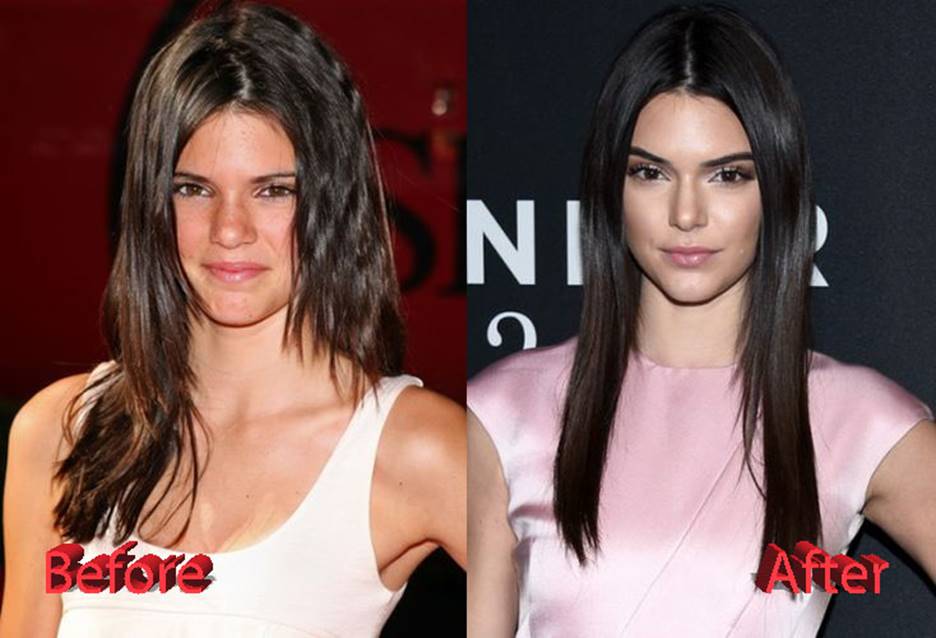 Kendall Jenner Before and After